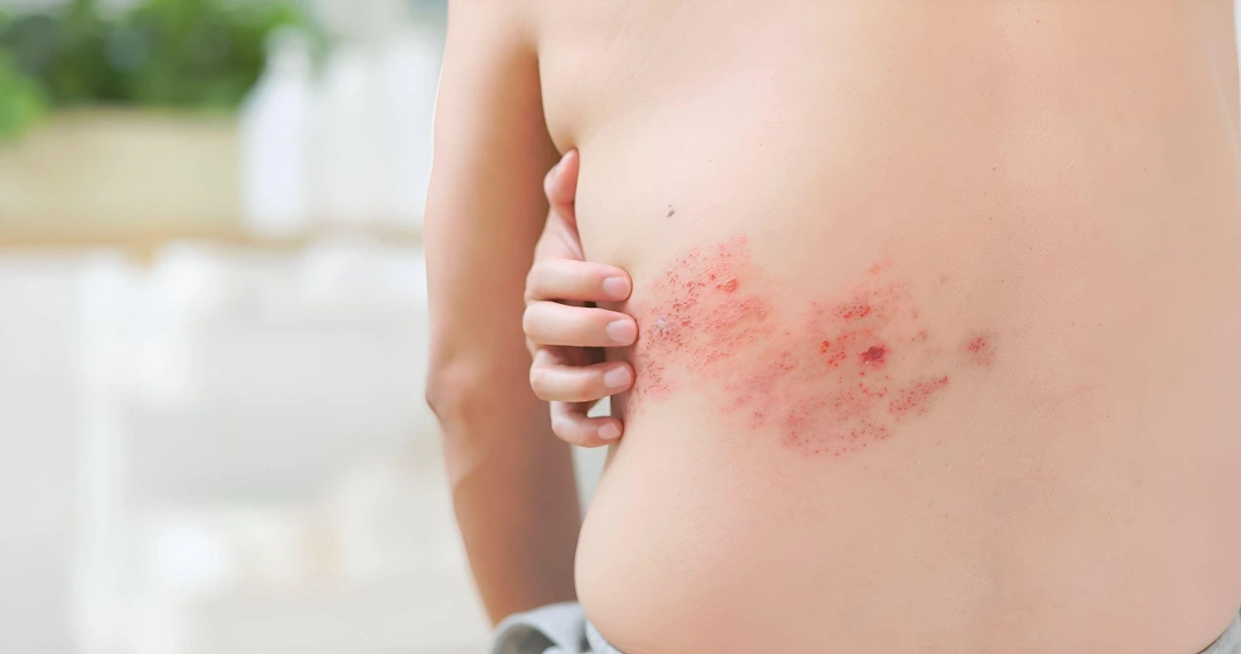 shingles symptoms