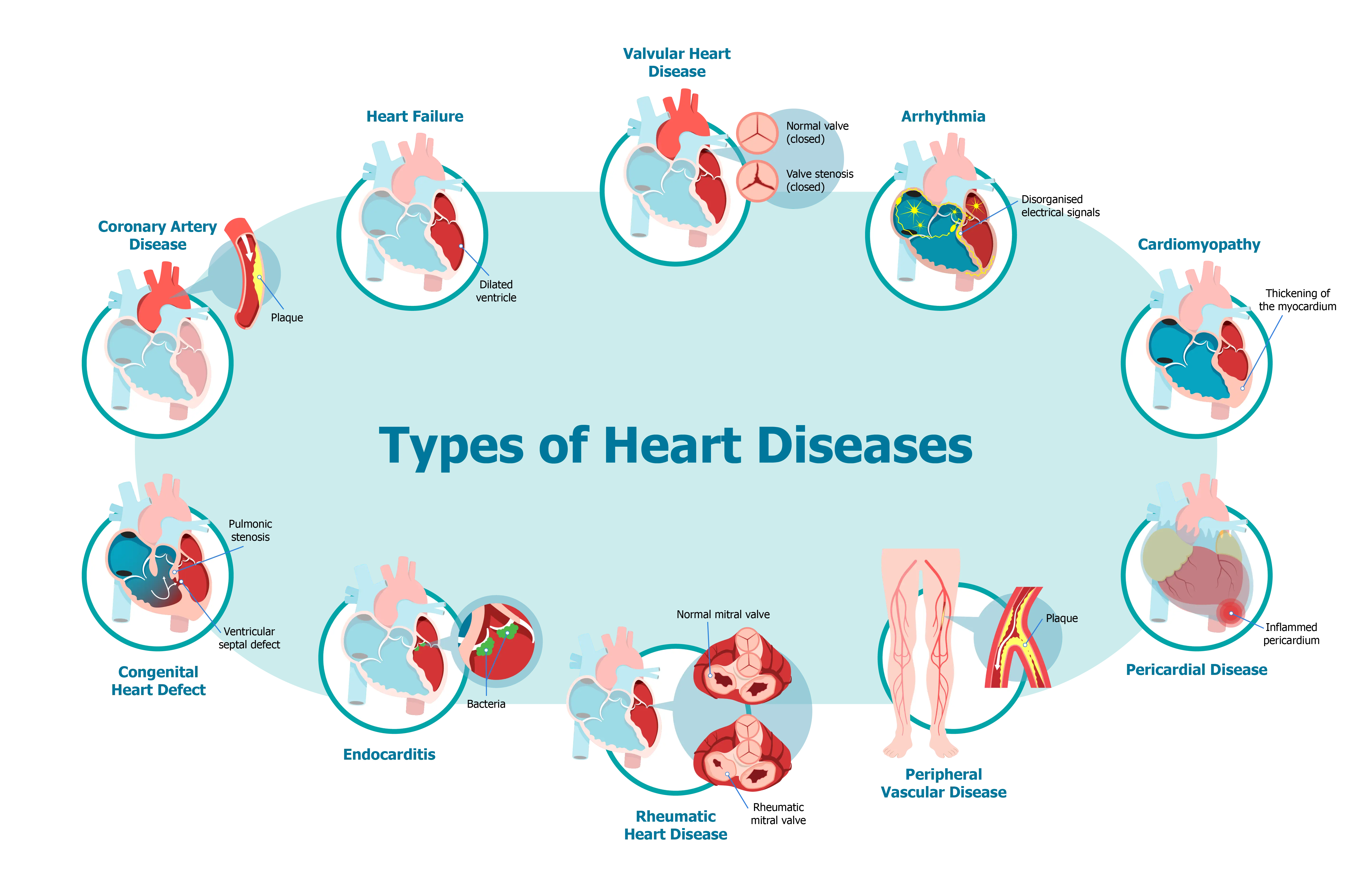 Types of heart diseases