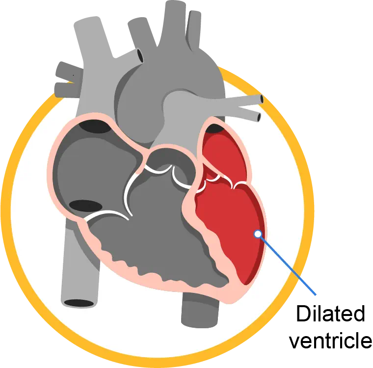 dilated ventricle