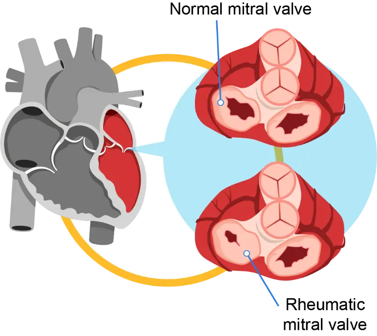 reumatik mitral valve