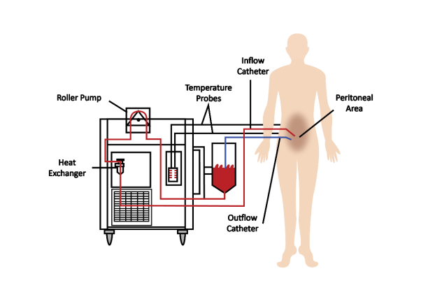 Hyperthermic Intraperitoneal Chemotherapy (HIPEC)