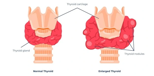 Normal and Enlarged Thyroid